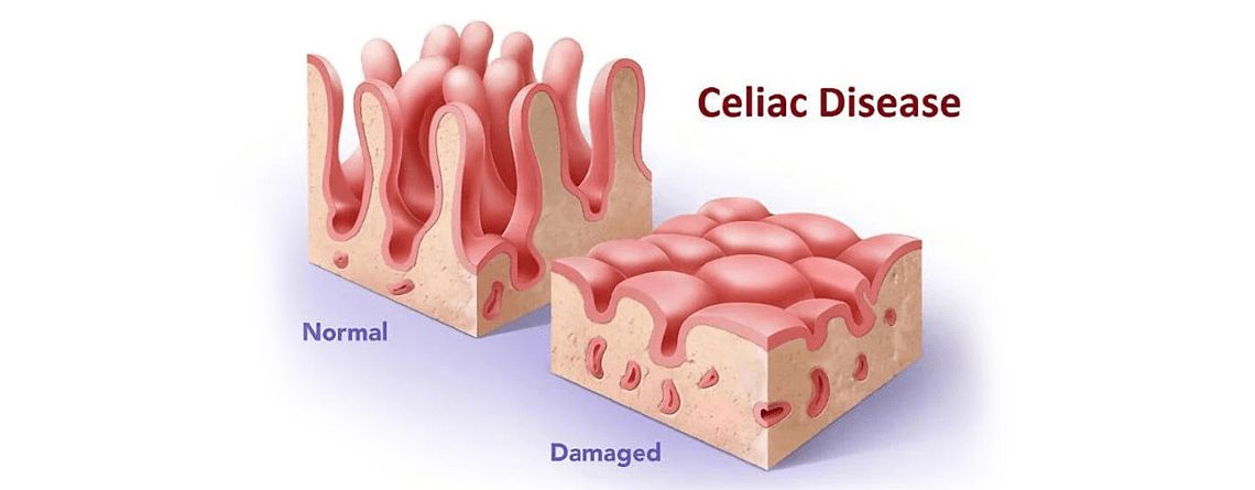 Are You Gluten-Intolerant or Celiac? Find Out Are You Gluten-Intolerant or Celiac? Find Out