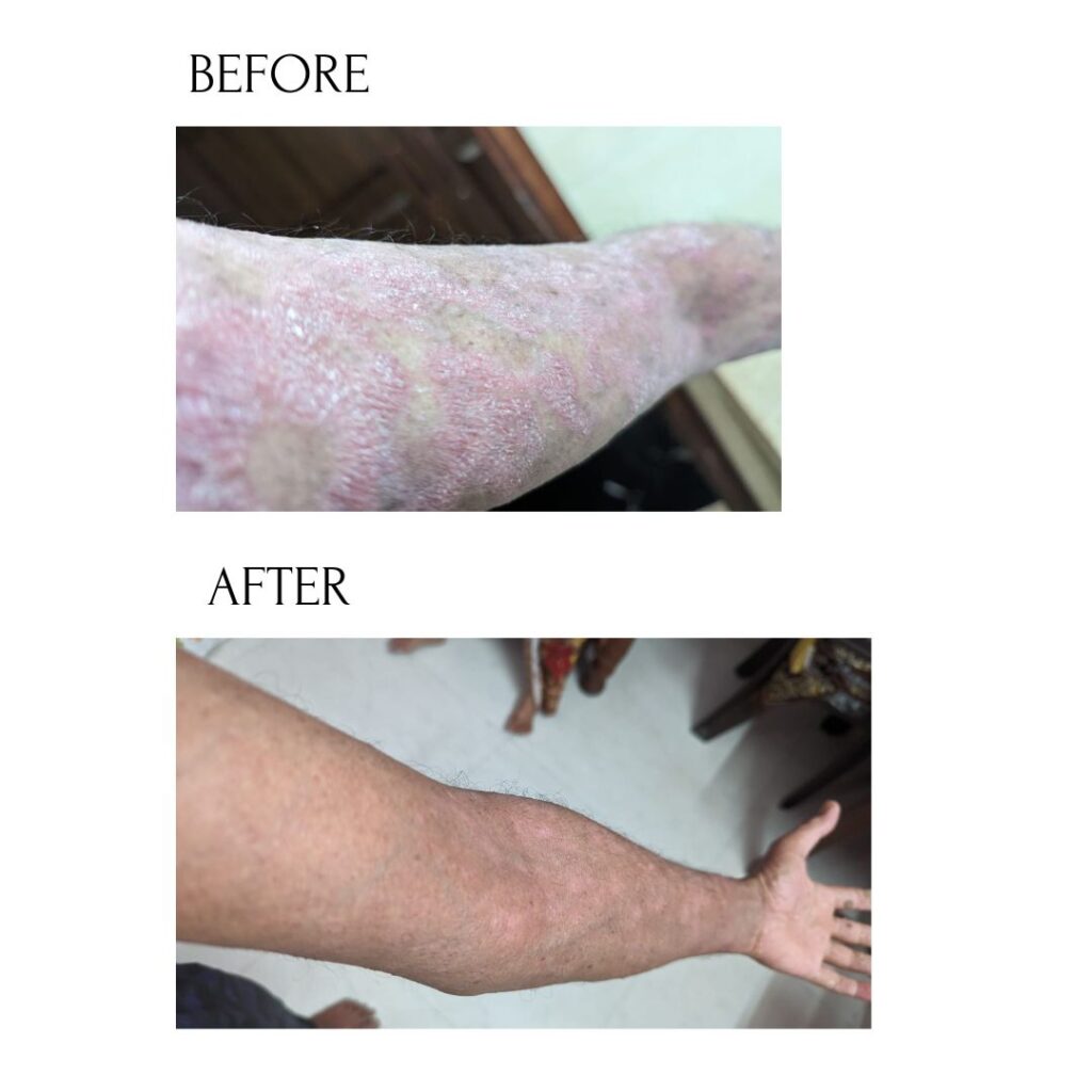 From 95% Psoriasis to 5%–10% on His Entire Body: A Success Story of Hope, Determination and Action From 95% Psoriasis to 5%–10% on His Entire Body: A Success Story of Hope, Determination and Action