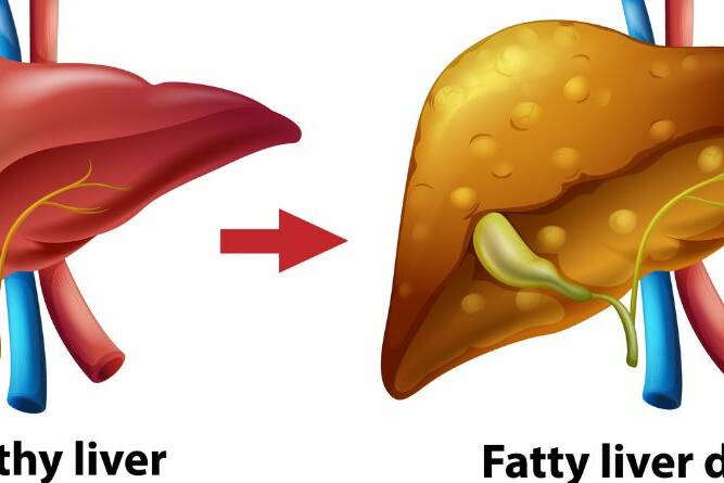 The Truth About Non-Alcoholic Fatty Liver Disease: What You’re Not Being Told