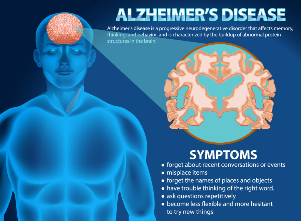 Protect Your Brain Health: Daily Habits for Managing Alzheimer’s and Dementia Informative poster of Alzheimer's disease illustration