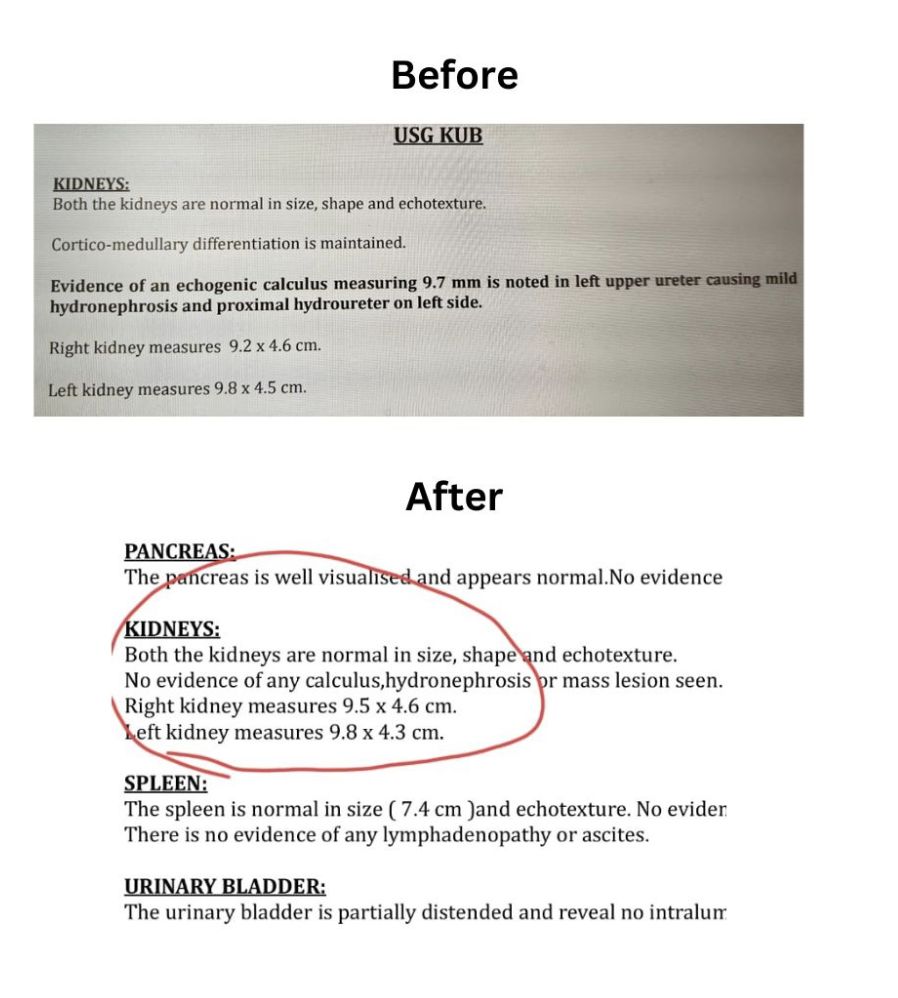 This 57-Year-Old Went From 9.7mm Kidney Stone to None! This 57-Year-Old Went From 9.7mm Kidney Stone to None!