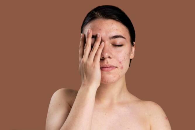 From Flare-Ups to Relief: A Proven Guide to Managing Eczema Naturally