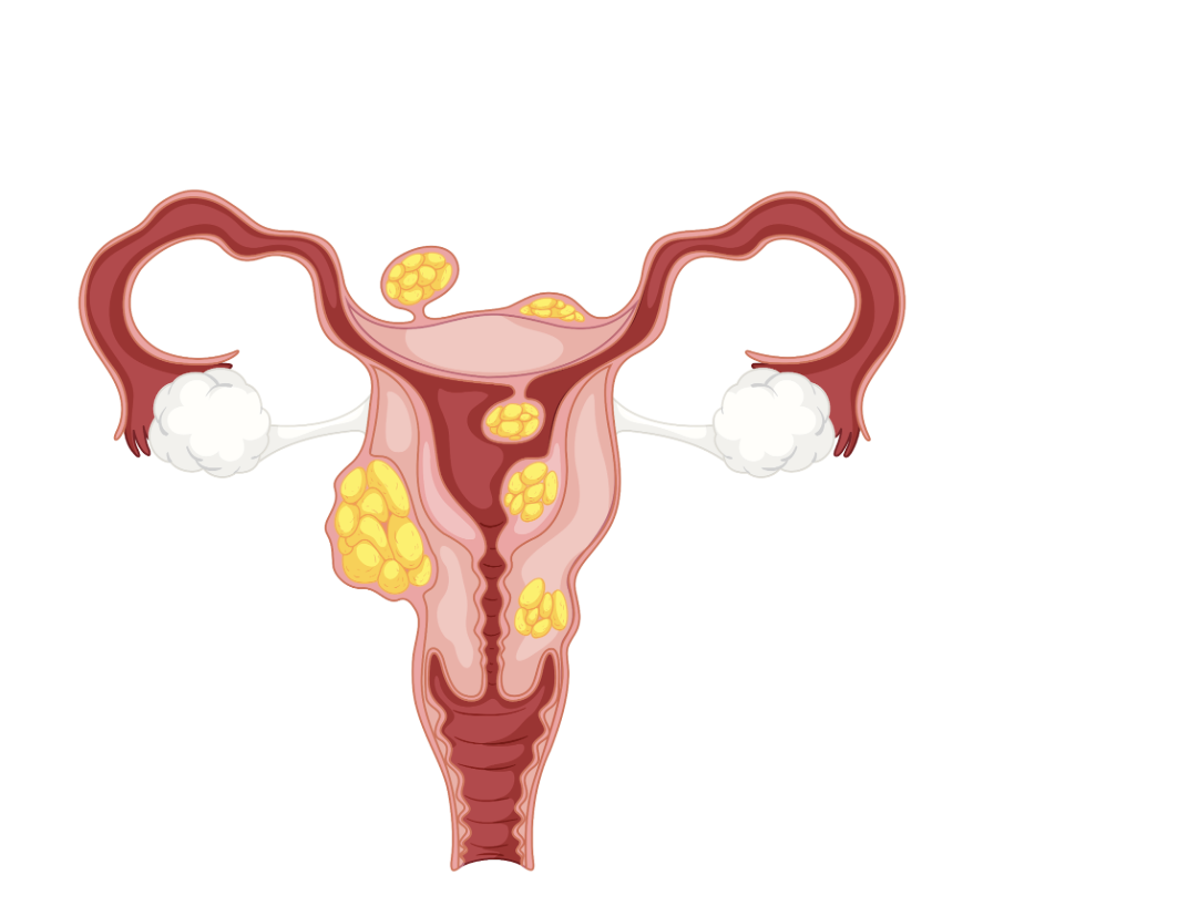 Fibroid Reducing Foods and Lifestyle Shifts That Truly Support Your Hormones