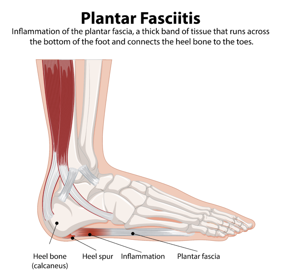 The Morning Heel Pain Trap: Why Your First Step Hurts and How to Fix Plantar Fasciitis The Morning Heel Pain Trap: Why Your First Step Hurts and How to Fix Plantar Fasciitis