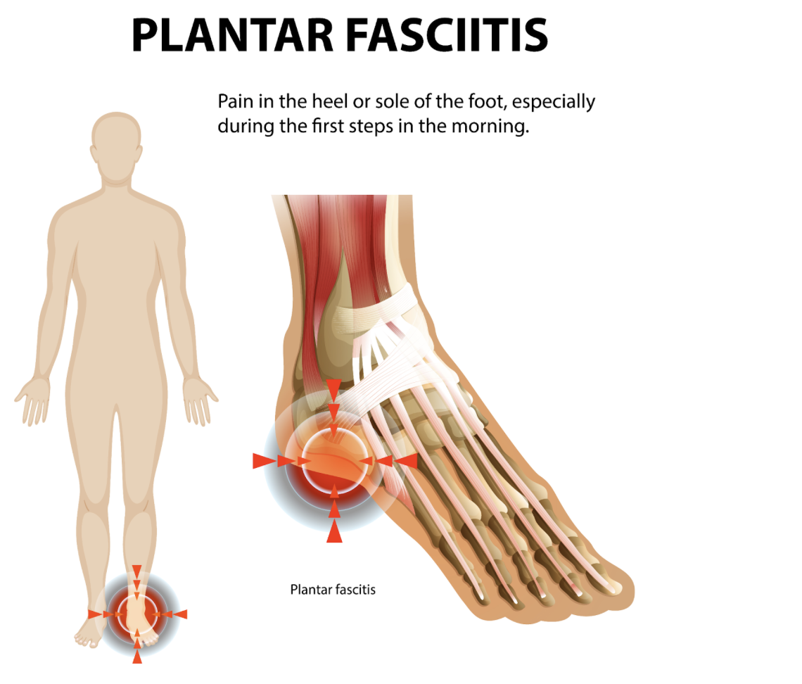 The Morning Heel Pain Trap: Why Your First Step Hurts and How to Fix Plantar Fasciitis The Morning Heel Pain Trap: Why Your First Step Hurts and How to Fix Plantar Fasciitis