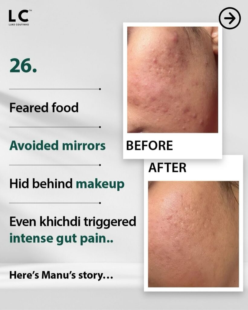 Manu Feared Food, Avoided Mirrors, and Hid Behind Makeup — This is Her Journey from Struggle to Strength before and after of intestinal healing