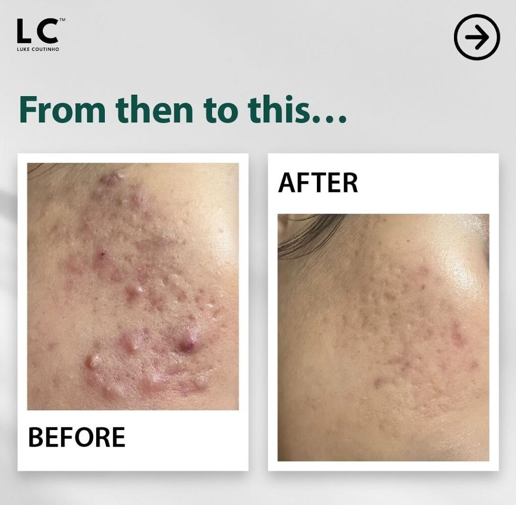 before and after of intestinal healing