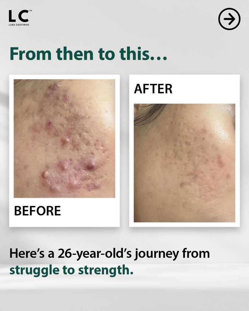 Manu Feared Food, Avoided Mirrors, and Hid Behind Makeup — This is Her Journey from Struggle to Strength before and after of intestinal healing