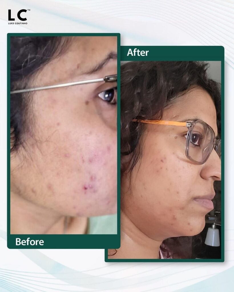 Face acne transformation before and after
