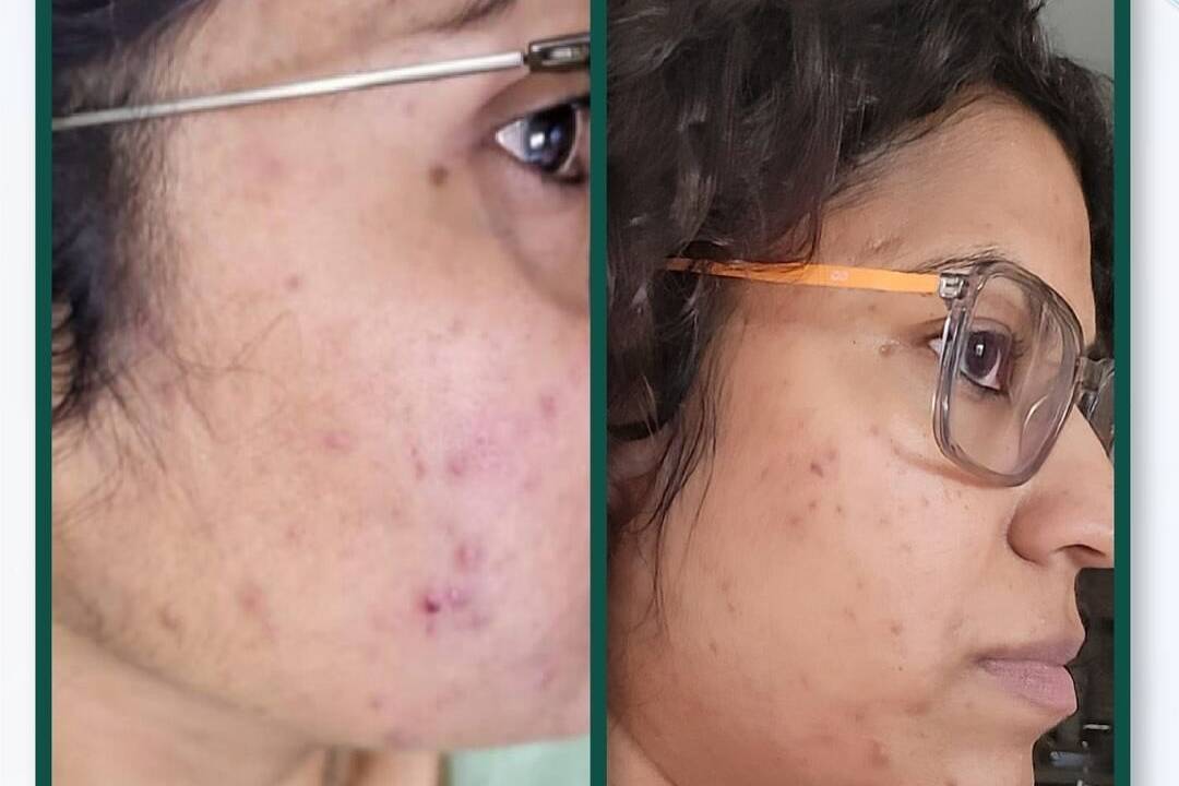 Face acne transformation before and after