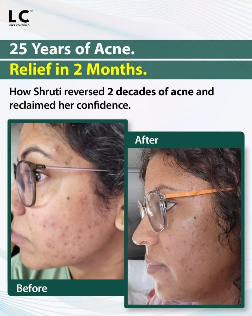 25 Years of Acne, 2 Months to Confidence: Shruti’s Incredible Skin Transformation Face acne transformation before and after