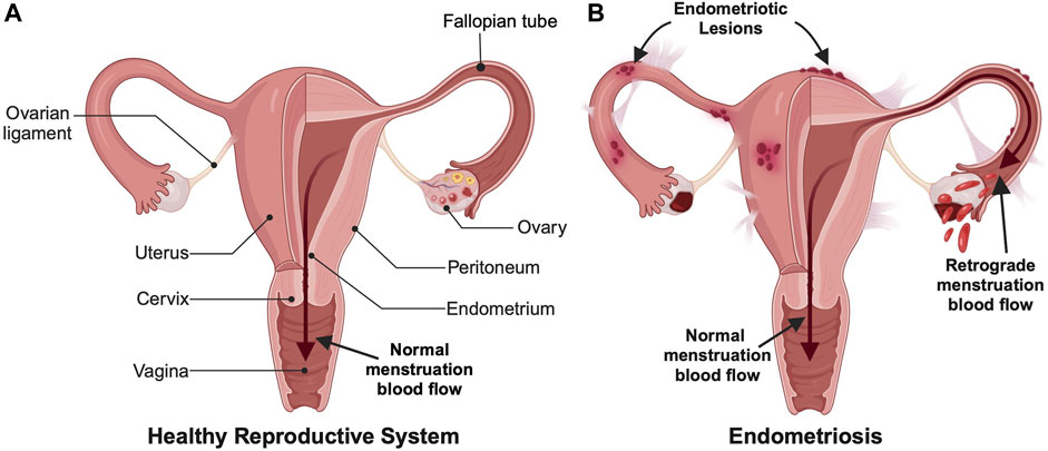 causes of endometriosis