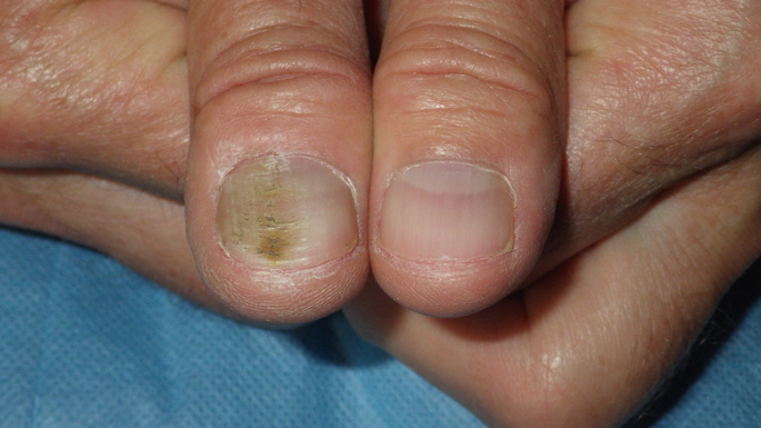 nail fungus