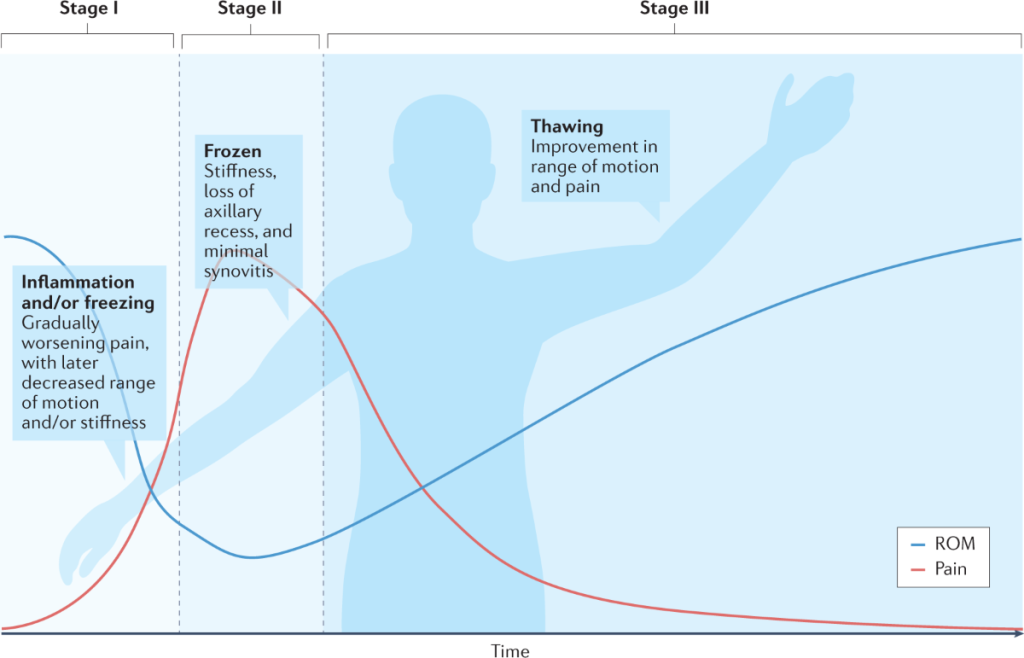 frozen shoulder pain and stiffness