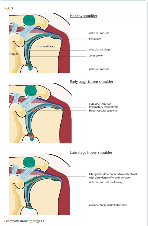 causes for frozen shoulder