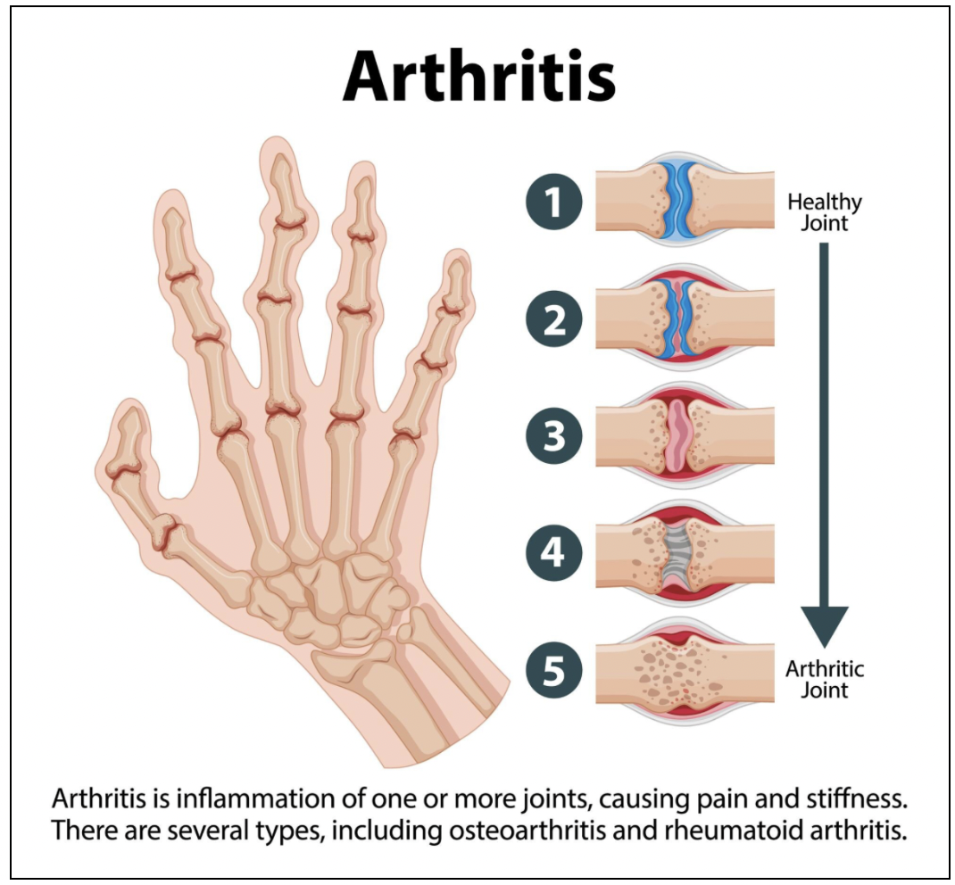 Why People in Their 20s and 30s Are Suddenly Getting Rheumatoid Arthritis Why People in Their 20s and 30s Are Suddenly Getting Rheumatoid Arthritis