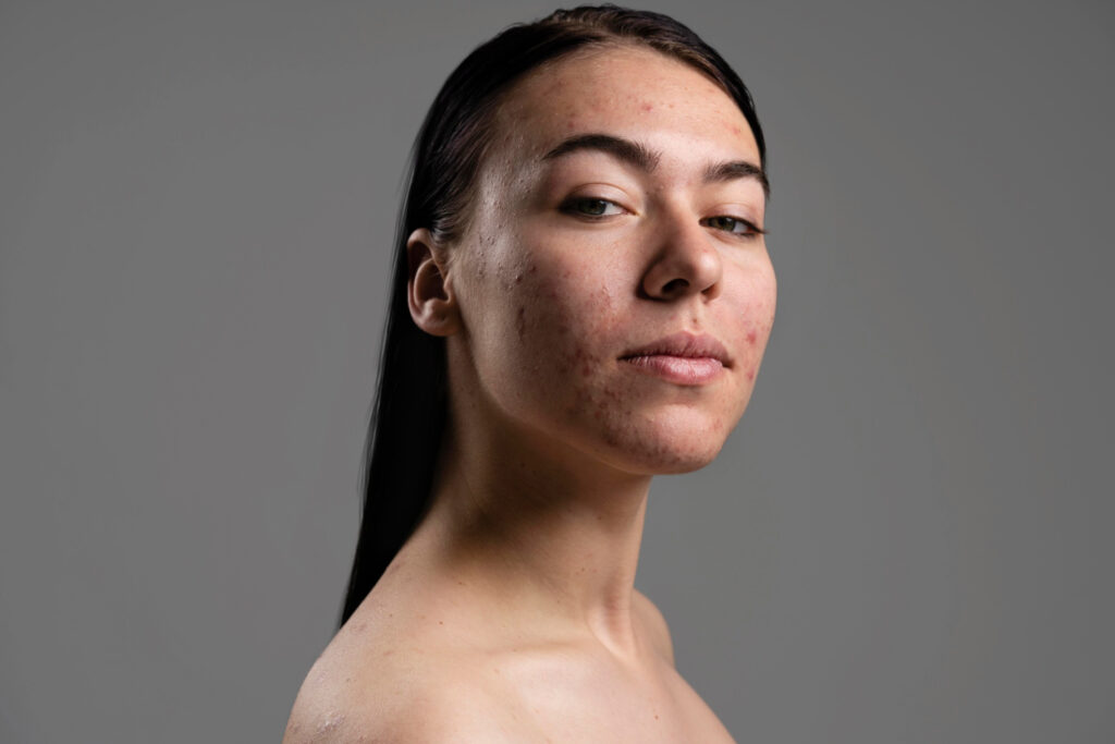 dark marks on face||melasma on the face|dark marks on face|melasma on face|dark marks on face|dark patches on forehead