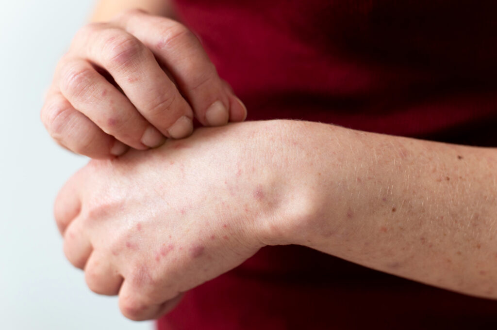 Can Natural Healing for Psoriasis and Eczema Really Work Long-Term? Find Out How healing skin from inside out