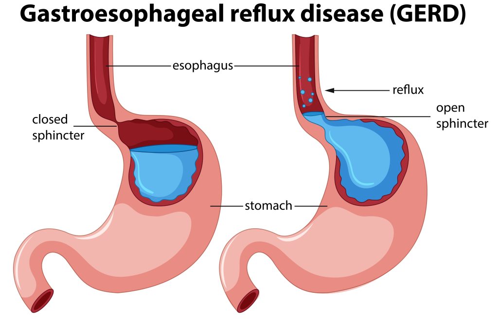 Before You Pop Another Antacid Like Candy, Read Mahesh’s Story GERD and heartburn relief