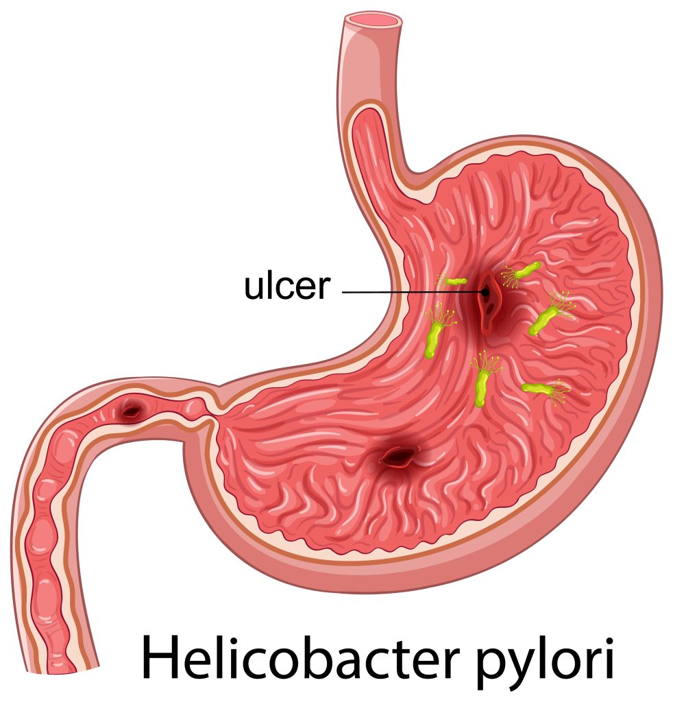 Before You Pop Another Antacid Like Candy, Read Mahesh’s Story H. pylori infection