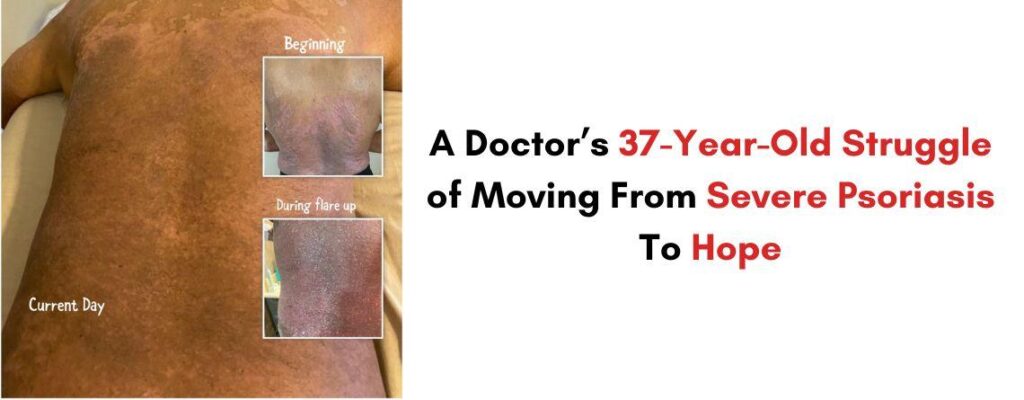 A Doctor’s 37-Year-Old Struggle of Moving From Severe Psoriasis To Hope|A Doctor’s 37-Year-Old Struggle of Moving From Severe Psoriasis To Hope|A Doctor’s 37-Year-Old Struggle of Moving From Severe Psoriasis To Hope|A Doctor’s 37-Year-Old Struggle of Moving From Severe Psoriasis To Hope