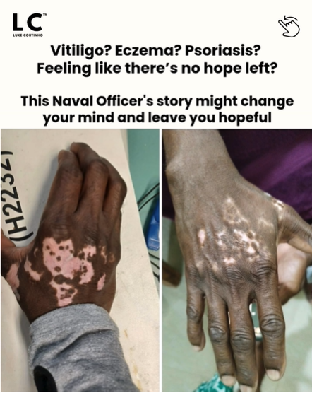 Can Natural Healing for Psoriasis and Eczema Really Work Long-Term? Find Out How healing for psoriasis and eczema
