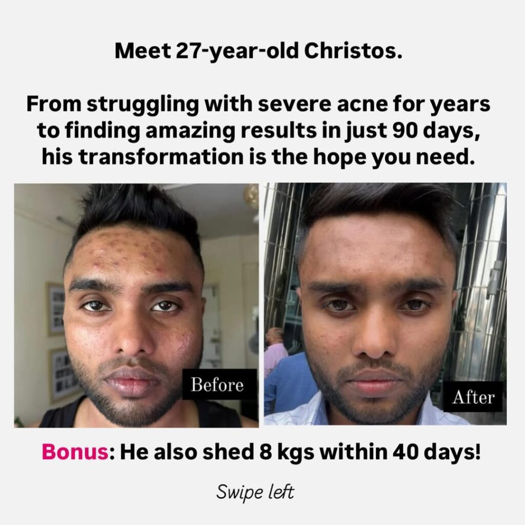 Can Natural Healing for Psoriasis and Eczema Really Work Long-Term? Find Out How healing for psoriasis