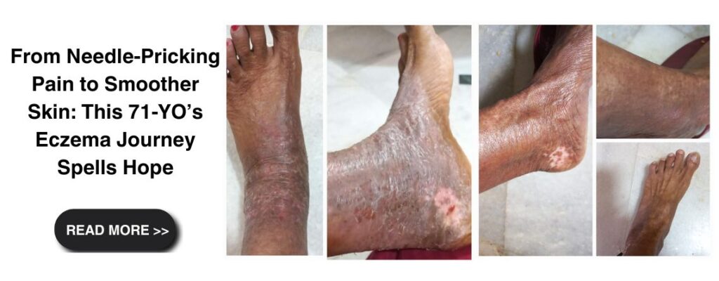From Needle-Pricking Pain to Smoother Skin: This 71-YO’s eczema Journey Spells Hope|From Needle-Pricking Pain to Smoother Skin: This 71-YO’s Eczema Journey Spells Hope|From Needle-Pricking Pain to Smoother Skin: This 71-YO’s Eczema Journey Spells Hope