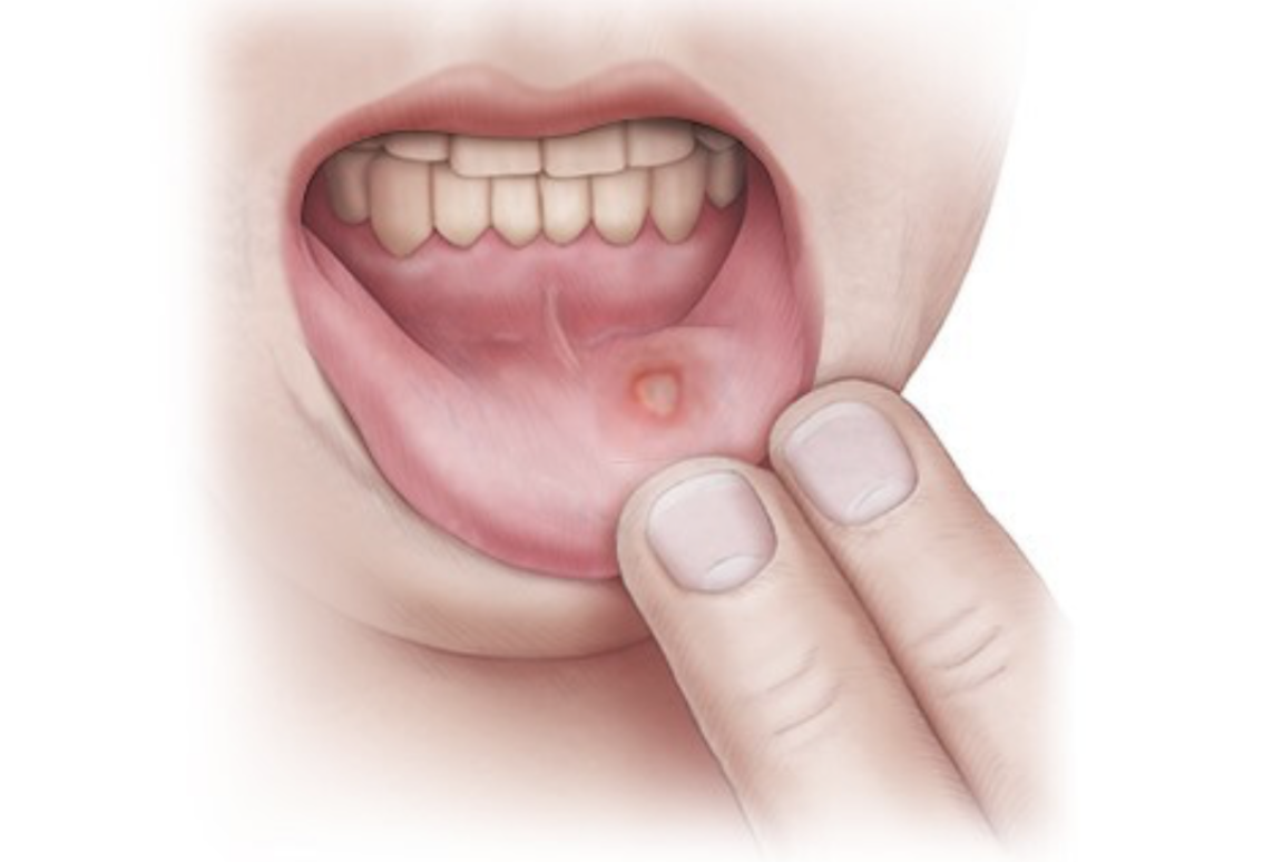 Close-up of ulcer in mouth showing common symptoms