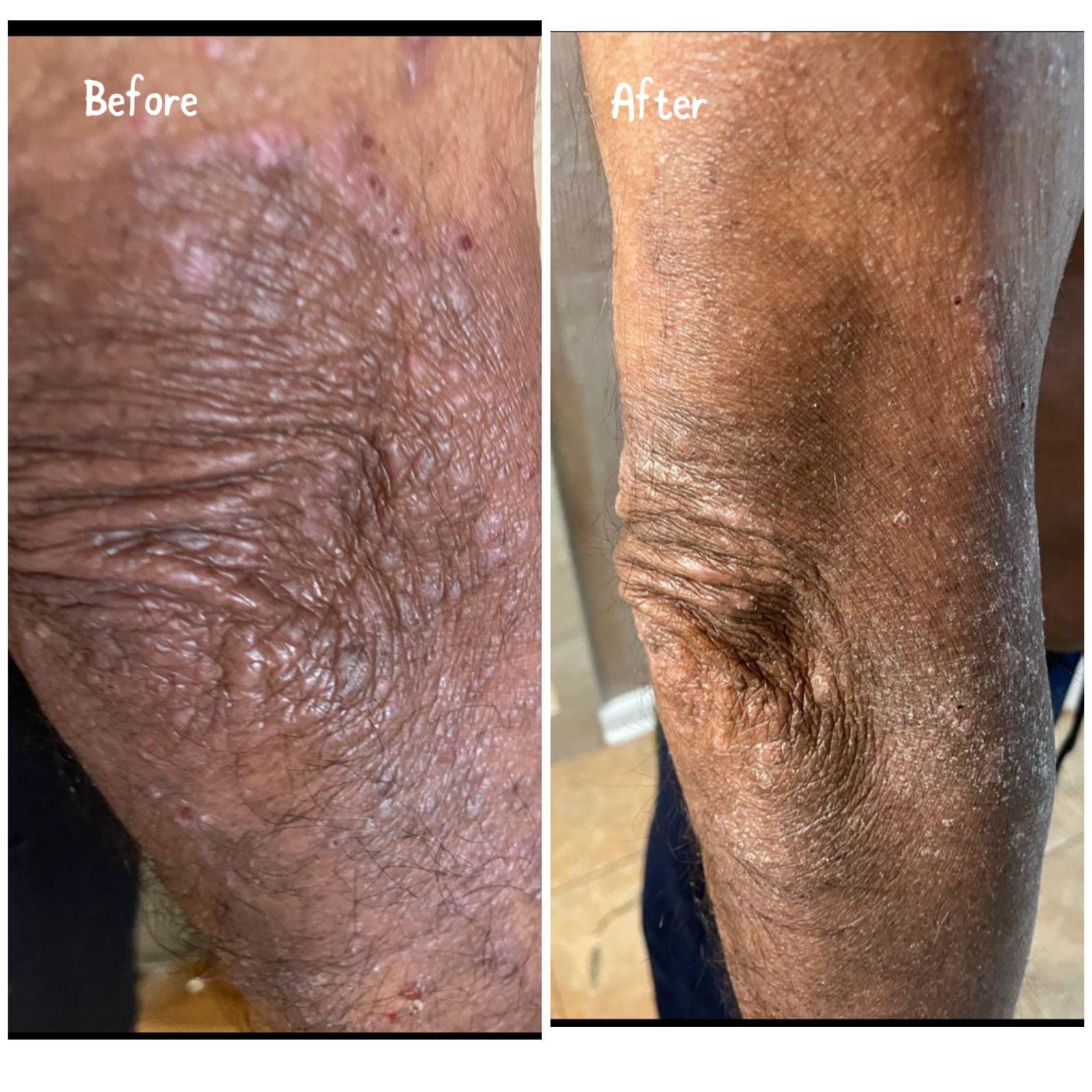 A Doctor’s 37-Year-Old Struggle of Moving From Severe Psoriasis To Hope