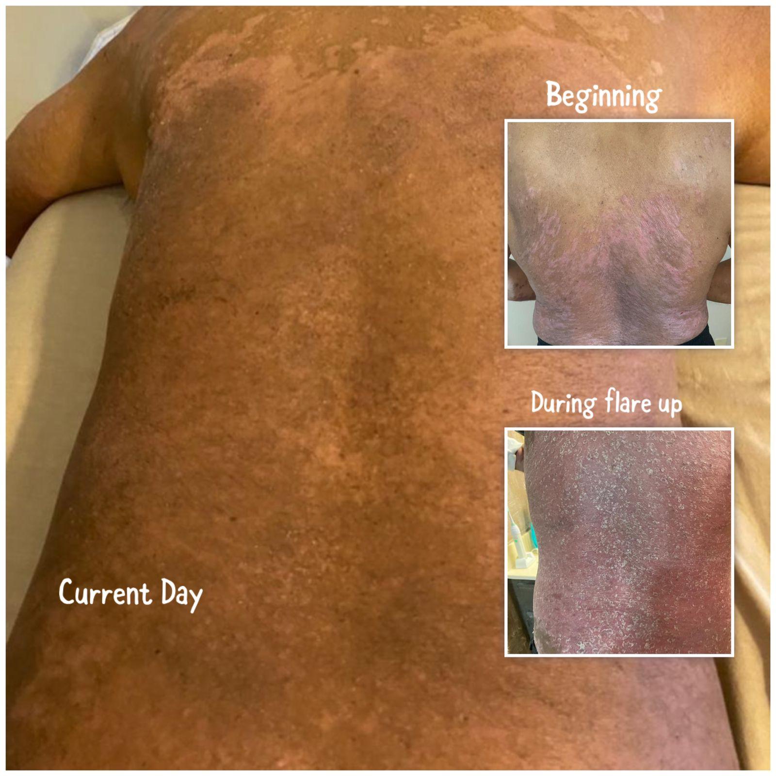 A Doctor’s 37-Year-Old Struggle of Moving From Severe Psoriasis To Hope
