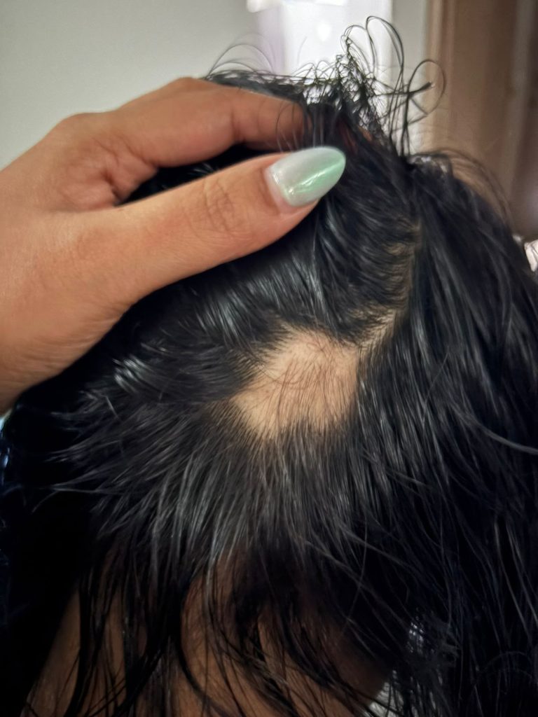 alopecia areata treatment