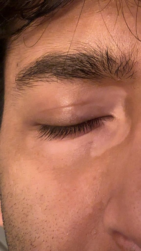 They Said Vitiligo Was Incurable. 90 Days of Fixing the Foundations — Repigmentation Followed. vitiligo management