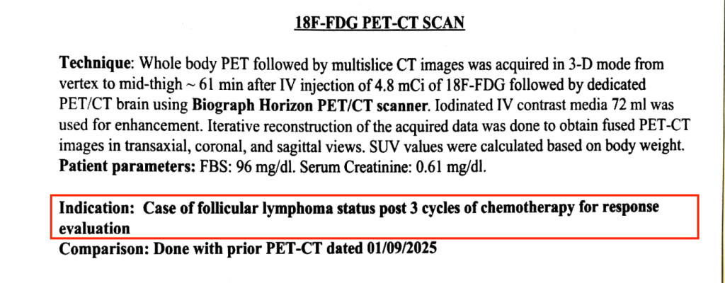 From Diagnosing Tumors to Facing Lymphoma Herself: Radiologist Dr. Sonia’s Remission Story non-Hodgkin lymphoma
