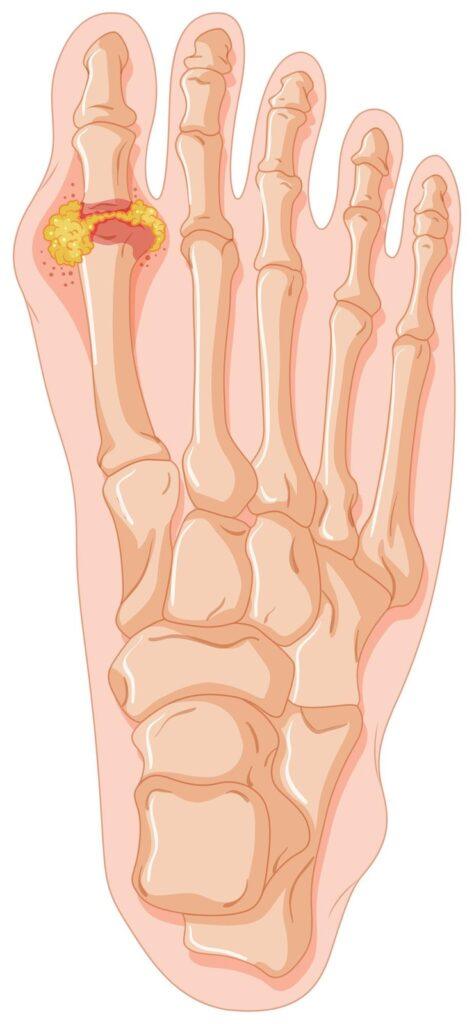 High Uric Acid and Gout? Natural Ways and Lifestyle Tips to Manage It High Uric Acid and Gout Try This Today