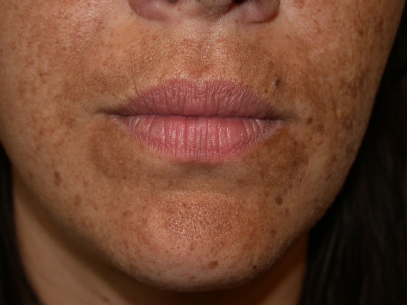 melasma on face