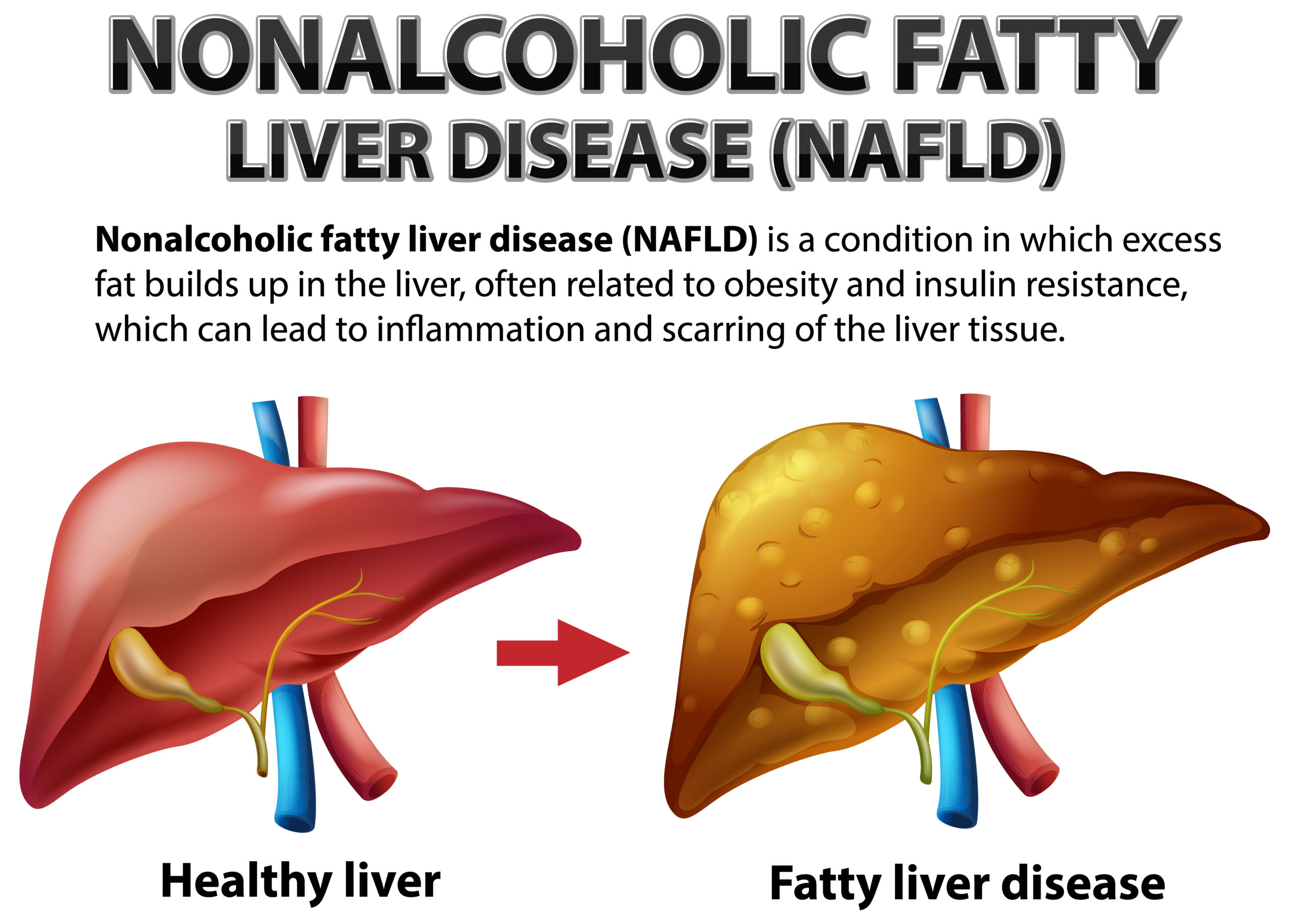 The Truth About Non-Alcoholic Fatty Liver Disease: What You’re Not Being Told non-alcoholic-fatty-liver