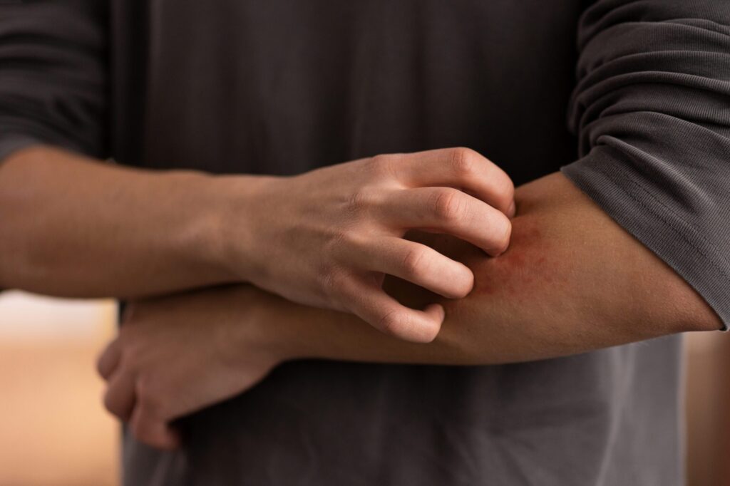 psoriasis-success-story|From 95% Psoriasis to 5%–10% on His Entire Body: A Success Story of Hope, Determination and Action|From 95% Psoriasis to 5%–10% on His Entire Body: A Success Story of Hope, Determination and Action|||||psoriasis-success-story|psoriasis-success-story|