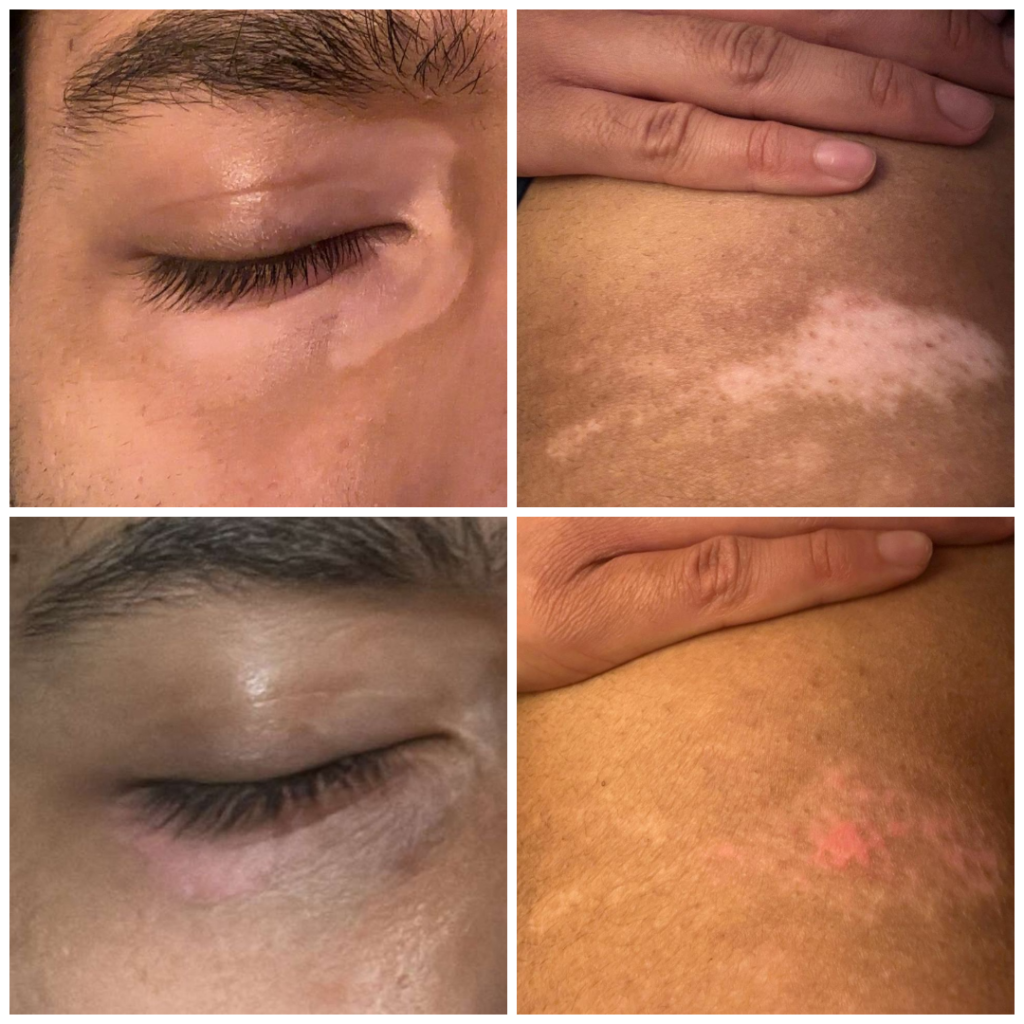 vitiligo treatment