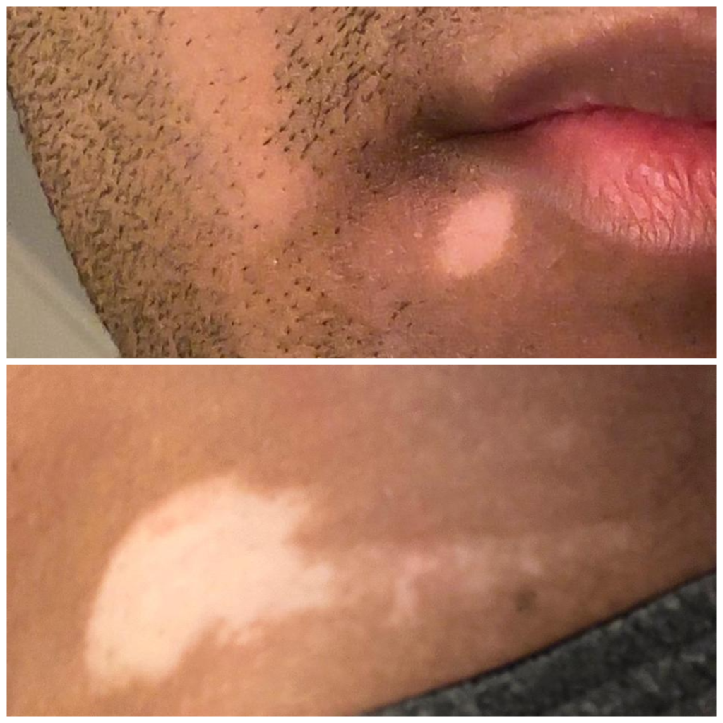 They Said Vitiligo Was Incurable. 90 Days of Fixing the Foundations — Repigmentation Followed. vitiligo