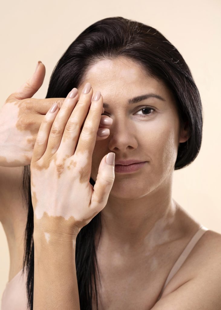 Living with Vitiligo: The Emotional Impact No One Talks About