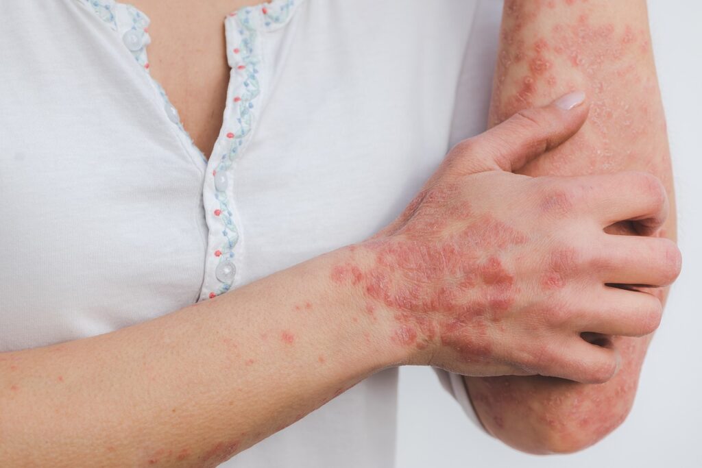 Beyond Skin-Deep: Holistic Lifestyle Changes for Psoriasis Relief and Remission Psoriasis: definition, symptoms, triggers