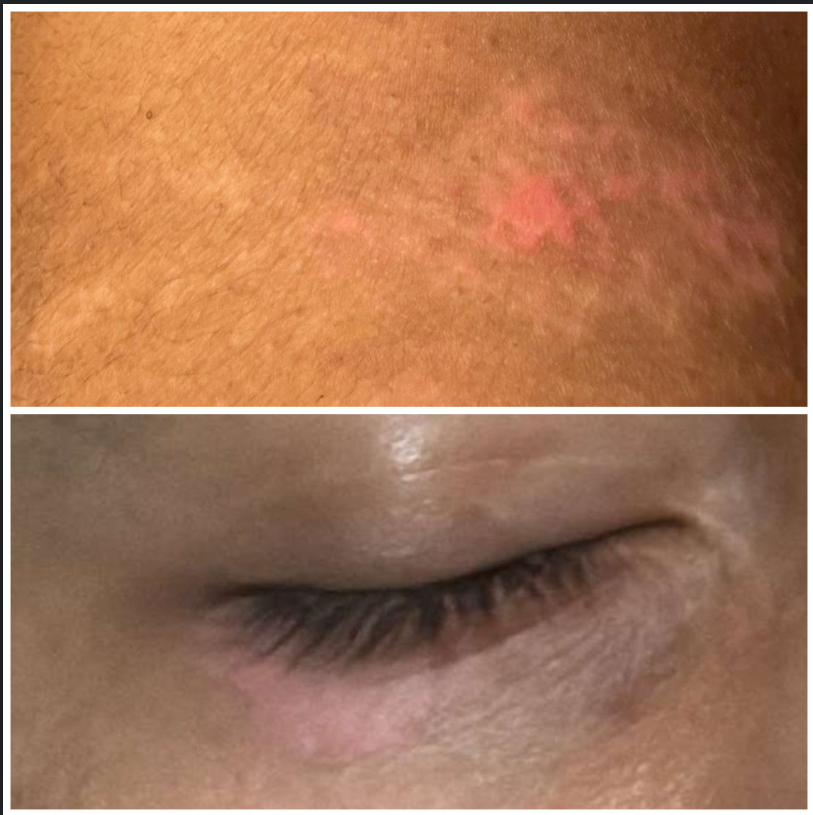 They Said Vitiligo Was Incurable. 90 Days of Fixing the Foundations — Repigmentation Followed. vitiligo repigmentation