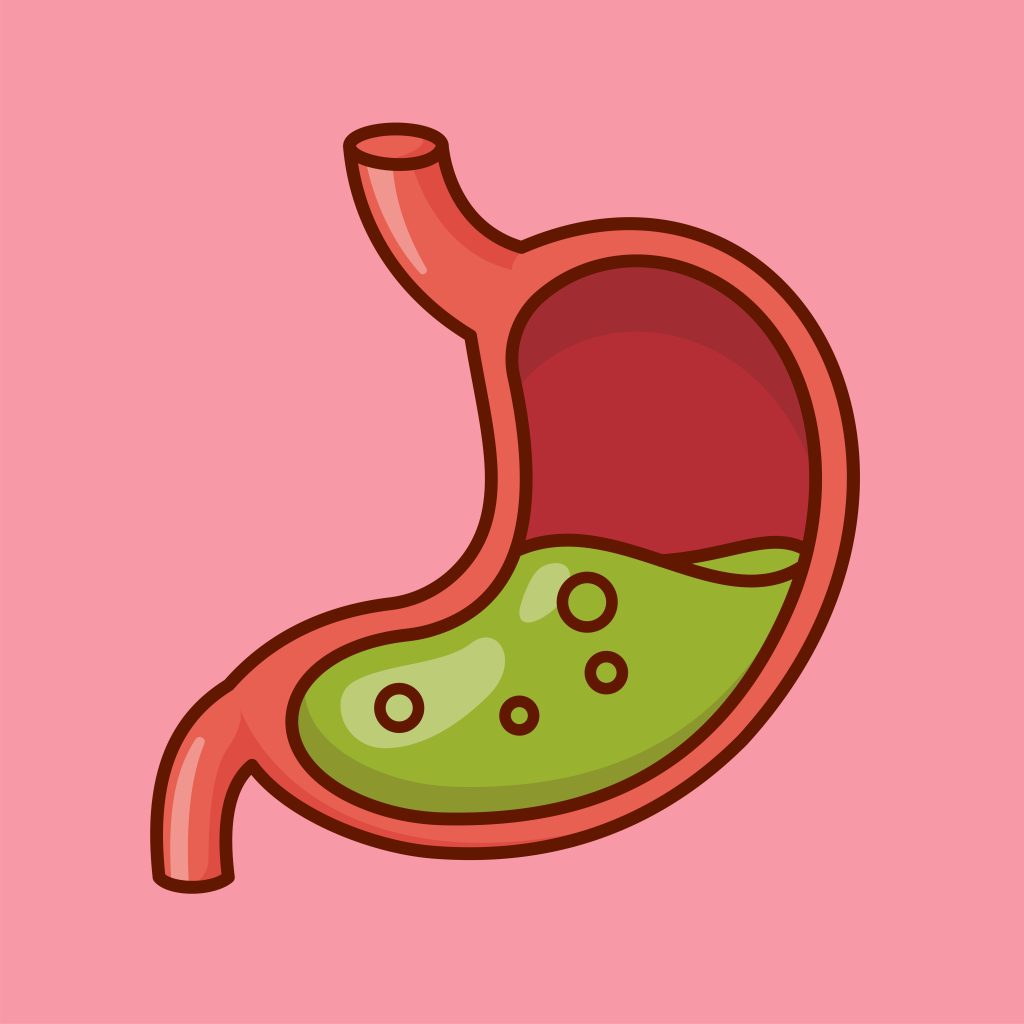 SIBO Explained: The Gut Condition Most People Are Getting Wrong low stomach acid SIBO