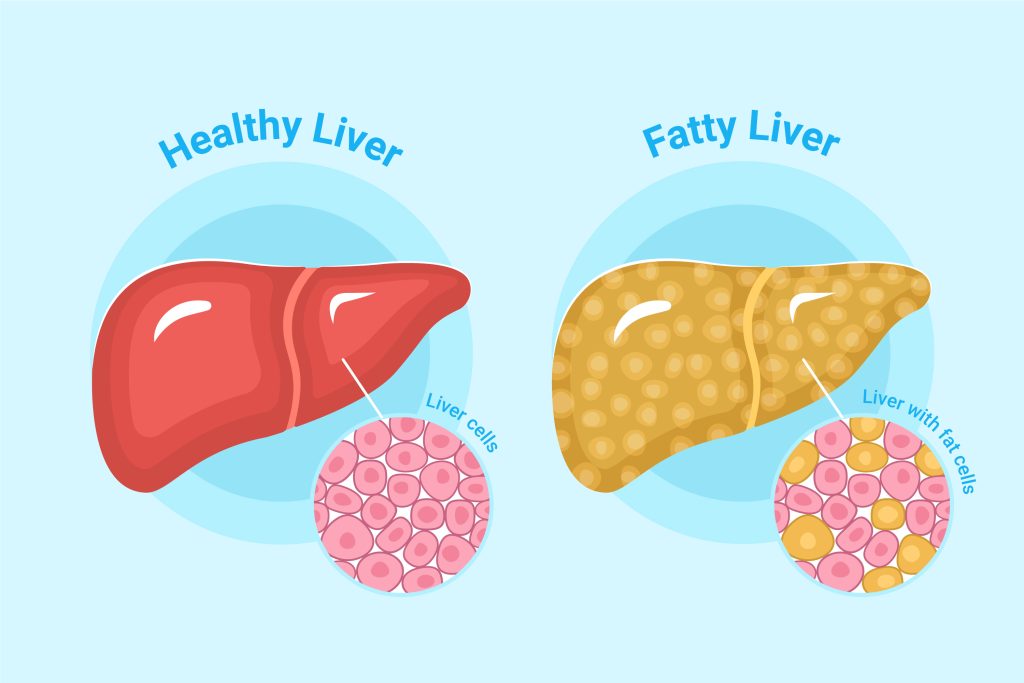 Grade 3 Fatty Liver Reversed in 6 Months: No Magic Pills, Just Foundational Medicine can fatty liver be reversed