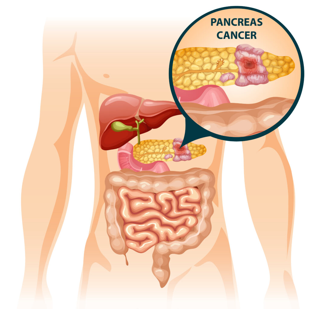 metastatic pancreatic cancer