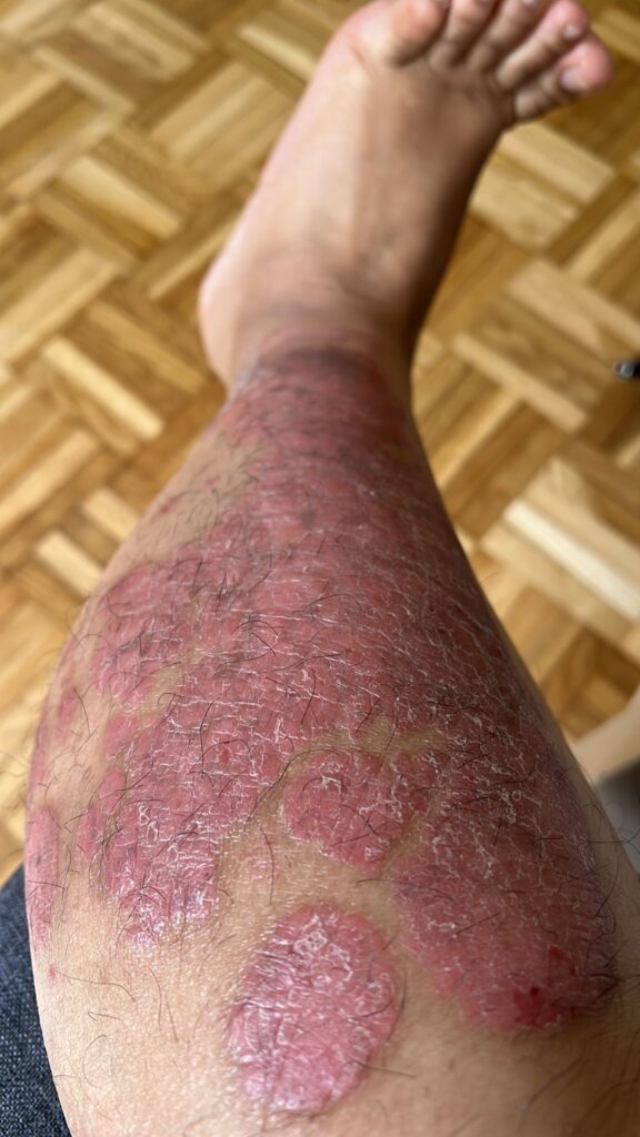 15 Years of Psoriasis, One Decision, and the Skin That Finally Healed psoriasis
